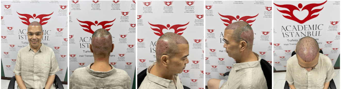Read more about the article My hair transplant in the Philippines is done!